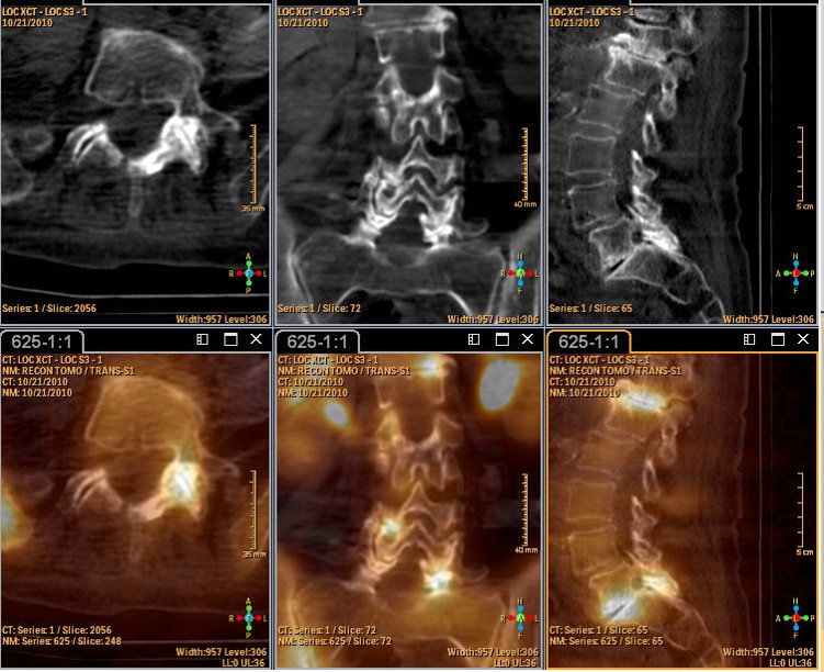 spect bone scan